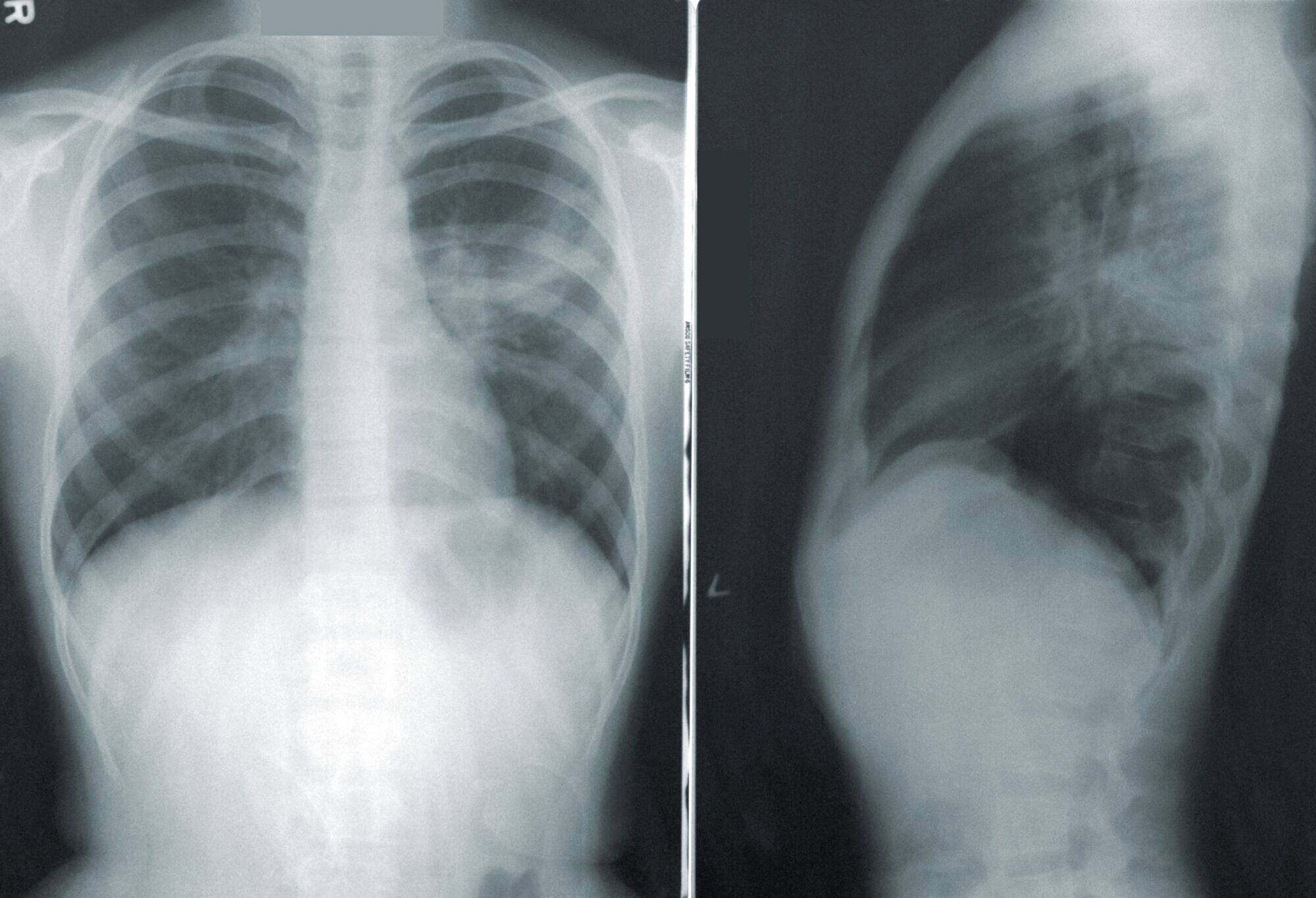 Pictures of a chest xray from front and side.